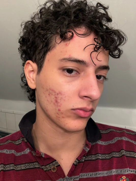 AI Blemish Remover Sample | VisualGPT