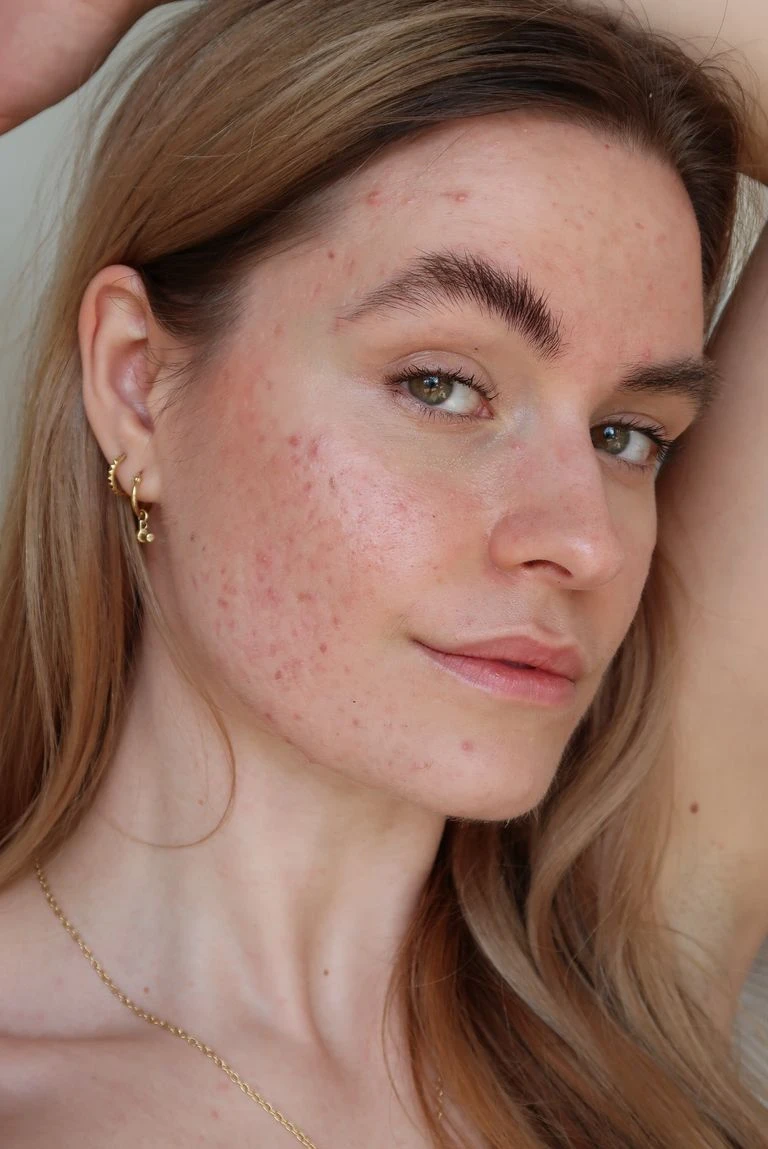 AI Blemish Remover Sample | VisualGPT